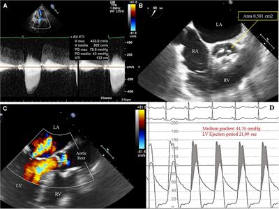 Case report: Self-expanding transcatheter valve implantation (Acurate Neo 2) in a very small native aortic annulus